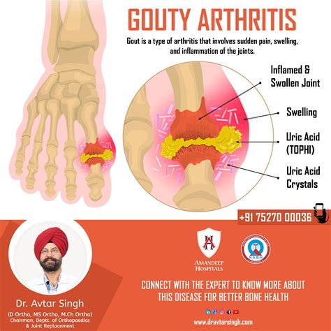 Common types of arthritis – Artofit