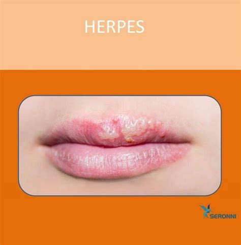 .90 index herpes
