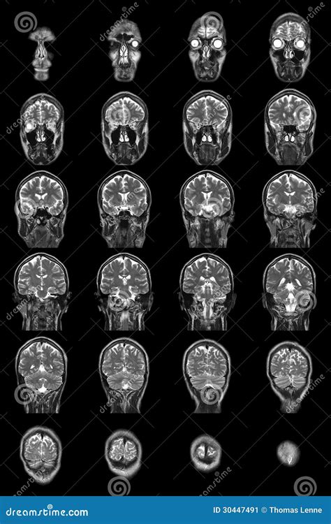 Normal Brain Mri