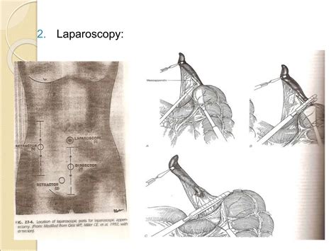 Image result for Appendicitis Position