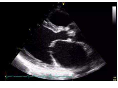 Echo Mitral Stenosis | PPTX