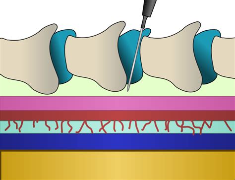 Image result for Epidural Injection
