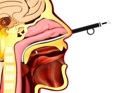 Balloon Sinus Dilation Procedure | ENT Associates of San Diego