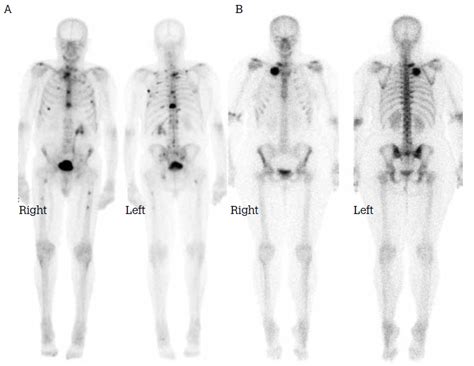 Image result for Normal Bone Scan