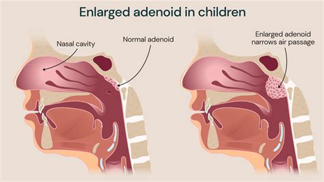 Ideal Age For Adenoid Removal