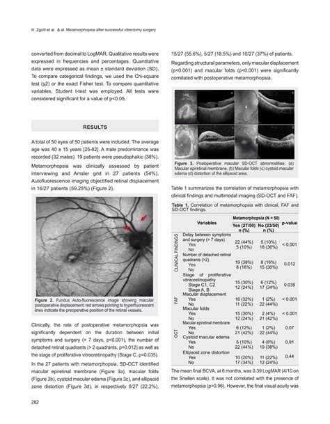 Macular hole sugery | PDF