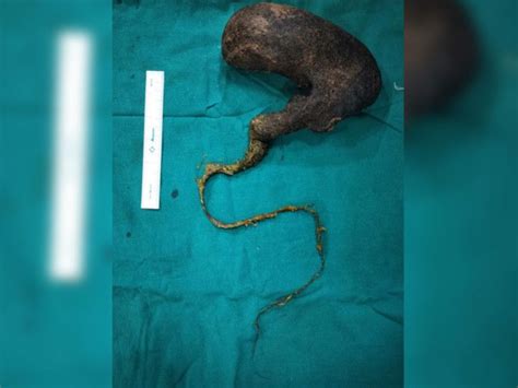 A 78-centimeter-long tuft of hair was pulled from the abdomen of a 13 ...