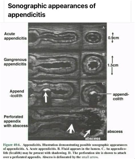 Appendicitis And Ultrasound