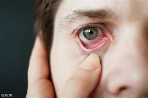 眼睛也会过敏，你中招了吗？|过敏性结膜炎|过敏性鼻炎|滴眼液|-健康界