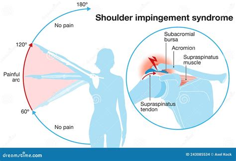 Rotator Cuff And Shoulder Impingement at Angela Lewandowski blog