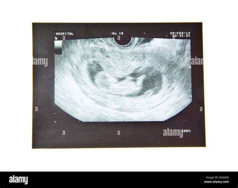 12 weeks baby ultrasound Image Stock Photo - Alamy