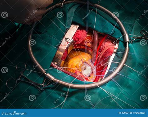 Mitral valve after repair stock image. Image of instruments - 43053185