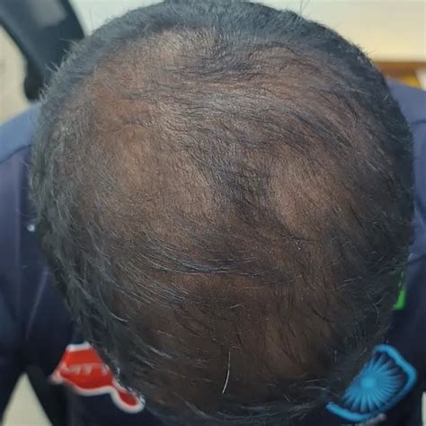 Best Hair Loss Treatment, Lab Test at Home | DermaQ