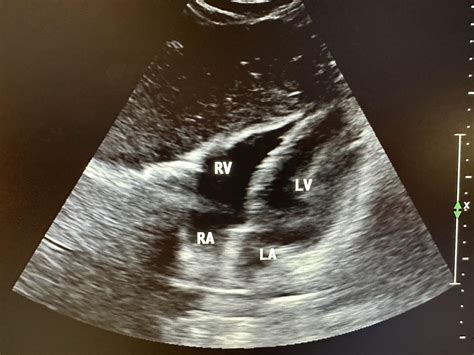 Ultrasonography Vs Ultrasound