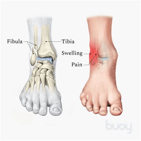 Ortho Globe | Understanding Ankle Fractures