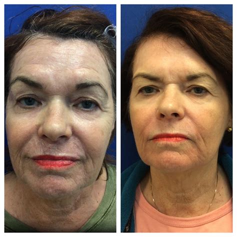 Fractional Laser Scar Treatment Services | Skin Resurfacing