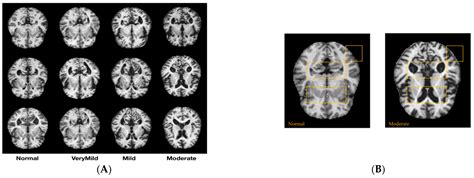 Novel Deep-Learning Approach for Automatic Diagnosis of Alzheimer’s Disease from MRI