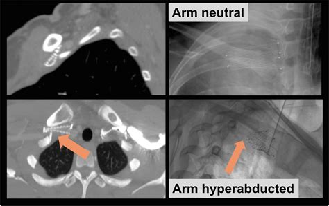 Results of a Flexible Patient Centered Approach to the Timing of ...
