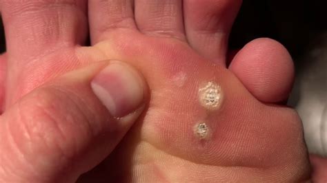 Image result for How Does Compound W Work