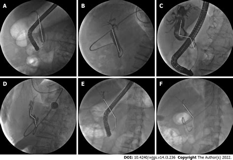 New common bile duct morphological subtypes: Risk predictors of common bile duct stone recurrence