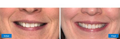 Mild Class II – Narrow Arches (SureSmile® Aligners) India