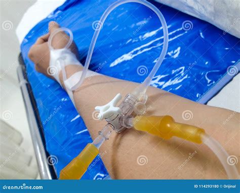 Hospitals Use a Saline Drip in an IV. Stock Photo - Image of liquid, patient: 114293180