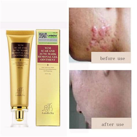 Buy 1PC Scar Acnes Stretch Gel Cream Marks Keloid Skin Burns Removal ...