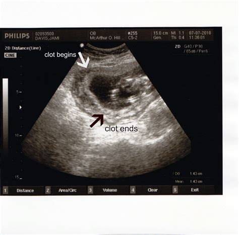 Is It Normal For Blood Clots After Birth at Eileen Perry blog