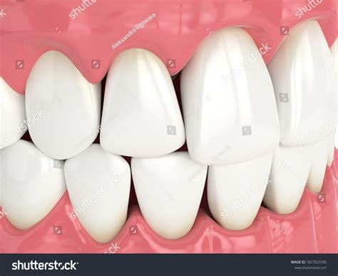 313 Gaps Between Teeth Images, Stock Photos & Vectors | Shutterstock