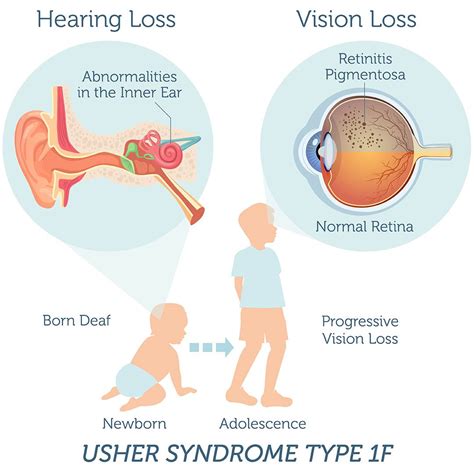 Ushers Syndrome Affects