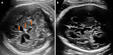 Ultrasound features of congenital cytomegalovirus infection in the first trimester: A case report
