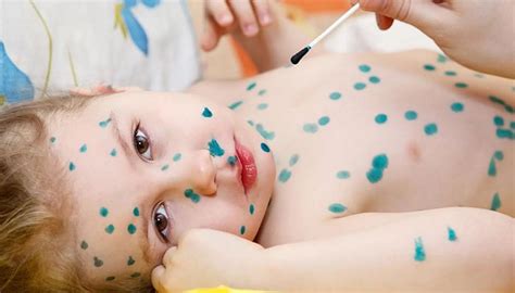 Cómo comienza la varicela en los niños: período de incubación, primeros signos y síntomas