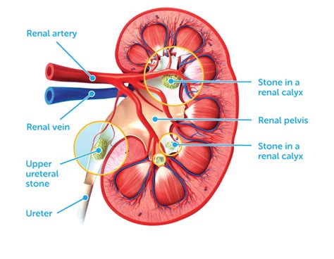 Kidney Stones - Mobile Medical
