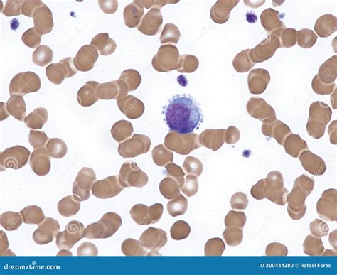 Splenic Lymphoma With Circulating Villous Lymphocytes. Stock Image | CartoonDealer.com #367358695