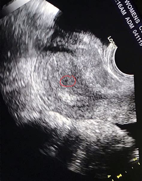 4 Week Vaginal Ultrasound Pictures