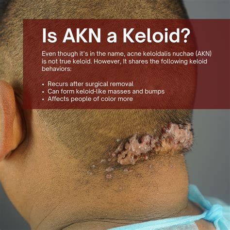 AKN or Keloid: What is Keloid? | Sanusi Umar, MD posted on the topic | LinkedIn