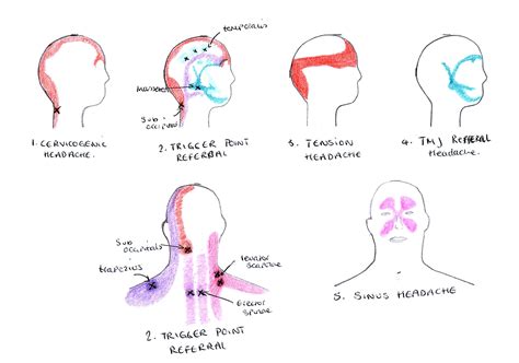 Headache In Top Of Head