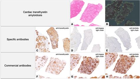 Frontiers | Amyloidosis: What does pathology offer? The evolving field ...