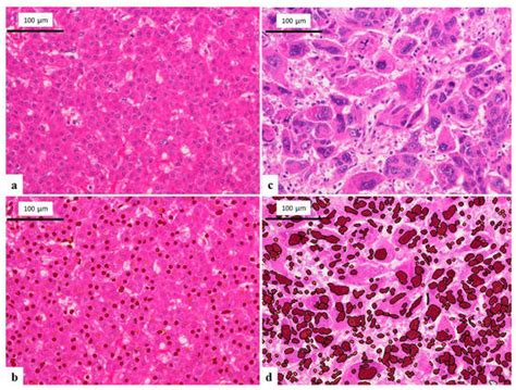 Cytological Comparison between Hepatocellular Carcinoma and ...
