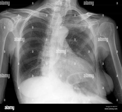 Enlarged Heart X Ray