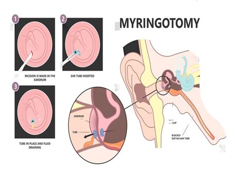 Myringotomy Surgery, Procedure & Treatment in India| Wockhardt Hospitals