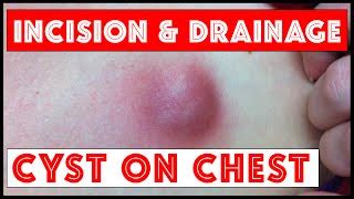 Image result for Exploding Chunky Cyst