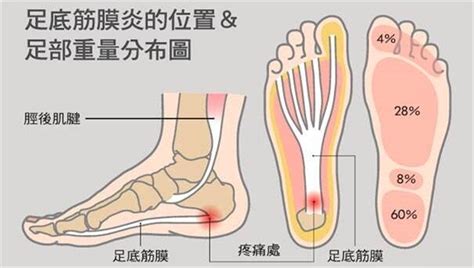 腳底痛≠足底筋膜炎 有這些症狀要注意！ | 元氣網