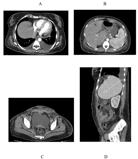 Image result for CT Scan with Contrast