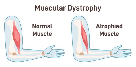 Rezultat imagine pentru Muscular Child