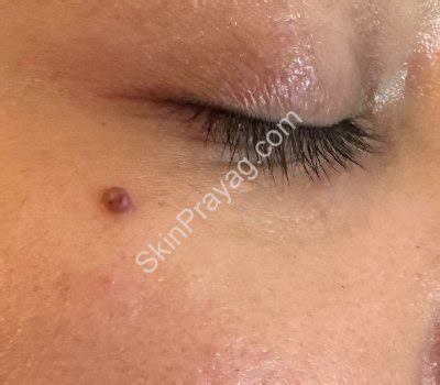 Mole Removal Images | Skin Prayag