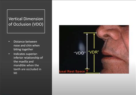 Complete Dentures – Vertical Dimension & Determinants of Occlusion ...