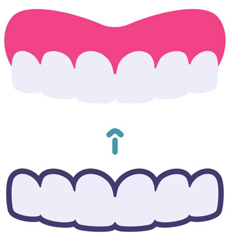 Best Invisalign Treatment in Rajkot | Affordable Clear Aligners ...