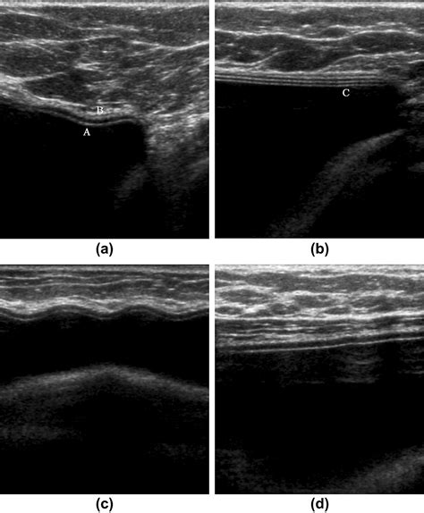 The sonographic appearances of breast implant rupture - Clinical Radiology