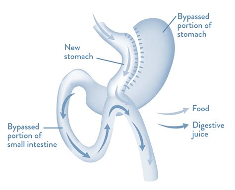 Mini Gastric Bypass